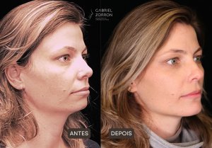 Foto do artigo harmonização facial dura quanto tempo. Nela, o de antes e depois de procedimento cirúrgico. mulher loira à esquerda com queixo pequeno e pouca marcação da mandíbula. mesma mulher à direita com o queixo e a mandíbula corrigidos, marcados com suavidade e naturalidade.