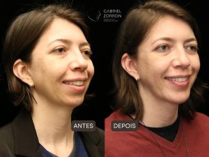 Foto do artigo harmonização facial dura quanto tempo. Nela, o de antes e depois de procedimento cirúrgico. mulher de cabelo castanho claro à esquerda com queixo pequeno e pouca marcação da mandíbula. mesma mulher à direita com o queixo e a mandíbula corrigidos, marcados com suavidade e naturalidade.