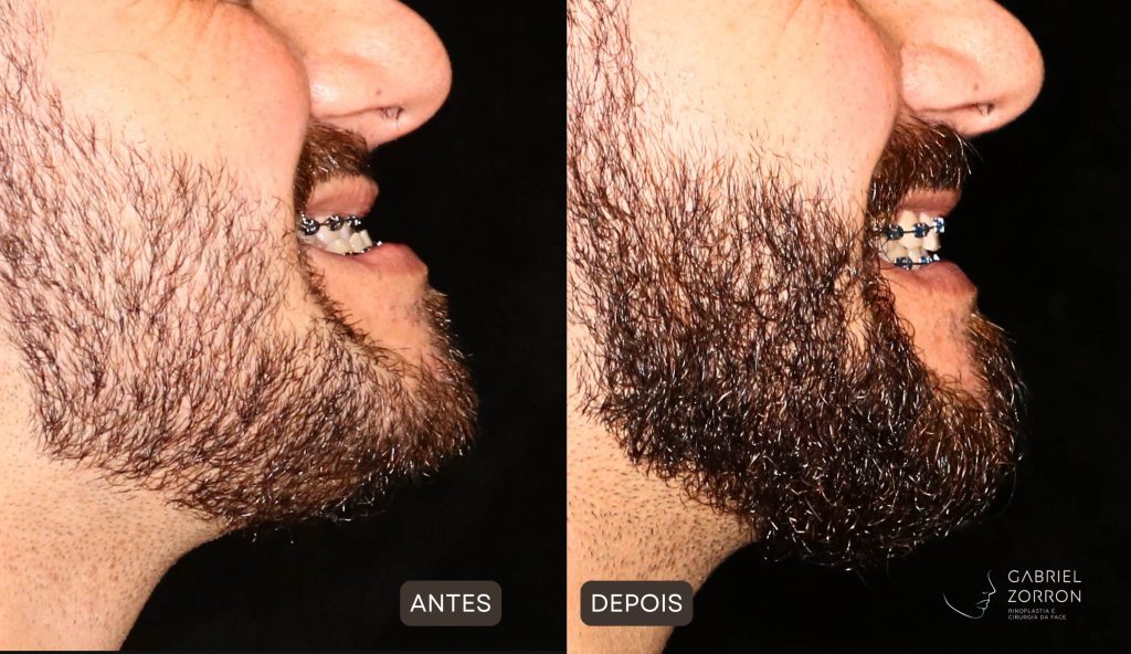 Foto de antes e depois de harmonização facial definitiva, homem à esquerda sem o procedimento e à direita após cirurgia ortognática classe 3.