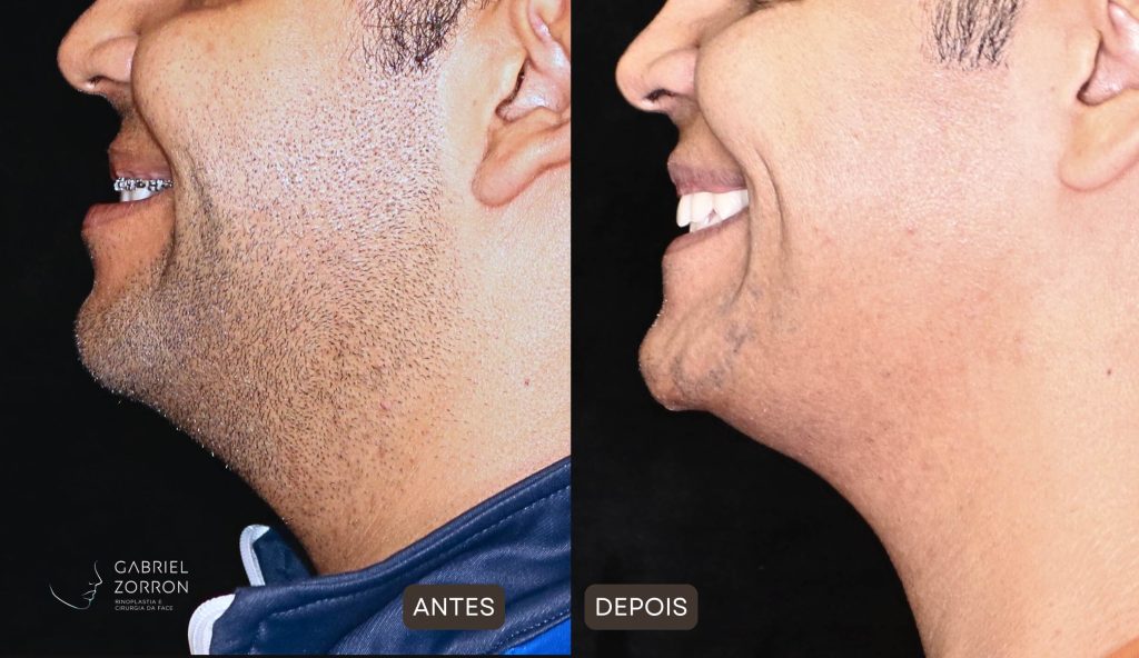 Foto de antes e depois de harmonização facial definitiva, homem à esquerda sem o procedimento e à direita após cirurgia ortognática.