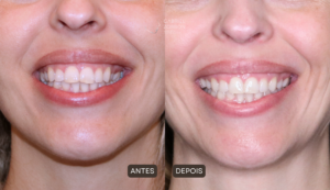 Foto de cirurgia ortognática antes e depois para correção de assimetria da face, à esquerda imagem de mandíbula e sorriso assimétricos e à direita alinhado.