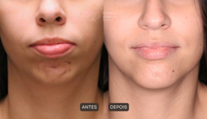 Foto de cirurgia ortognática antes e depois para correção de assimetria da face, à esquerda imagem de mandíbula e sorriso assimétricos e à direita alinhado.