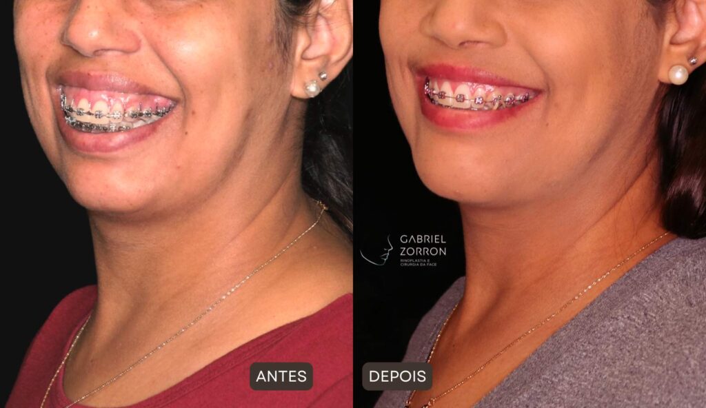 Foto de antes e depois de harmonização facial definitiva, mulher à esquerda sem o procedimento e à direita após cirurgia ortognática.