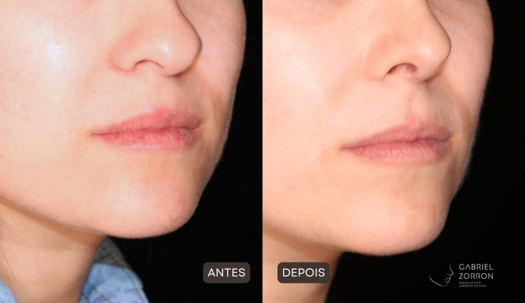 Foto de harmonização facial definitiva, mulher antes da Rinoplastia à esquerda e com Rinoplastia à direita.