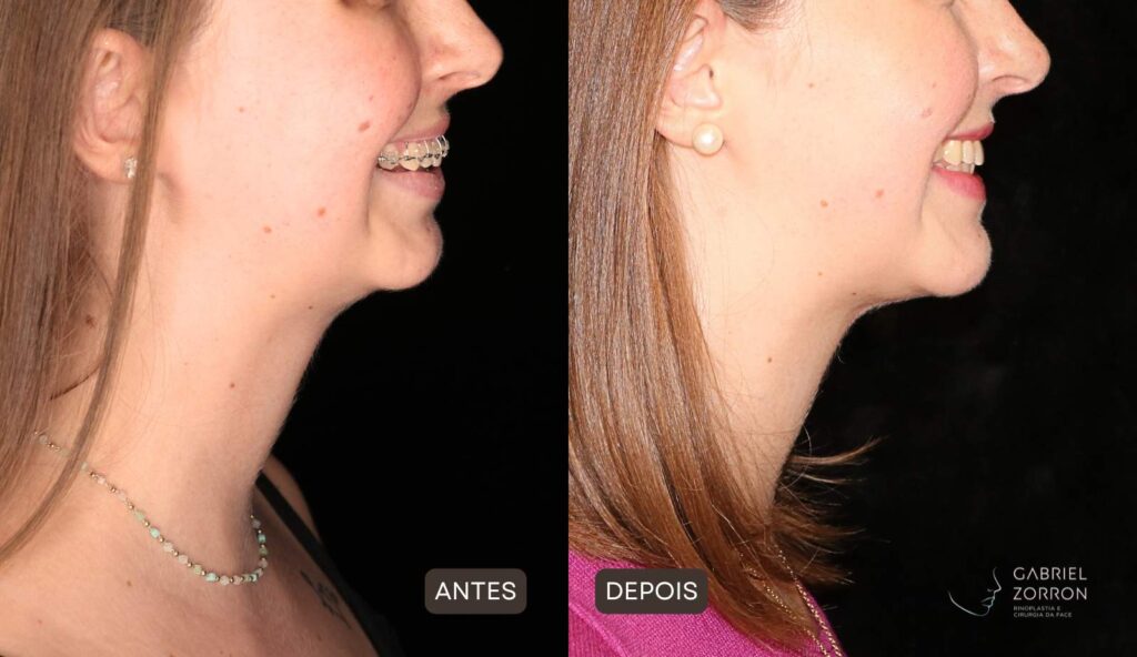 Foto de antes e depois de harmonização facial definitiva, mulher à esquerda sem o procedimento e à direita após cirurgia ortognática para correção de queixo retraído.