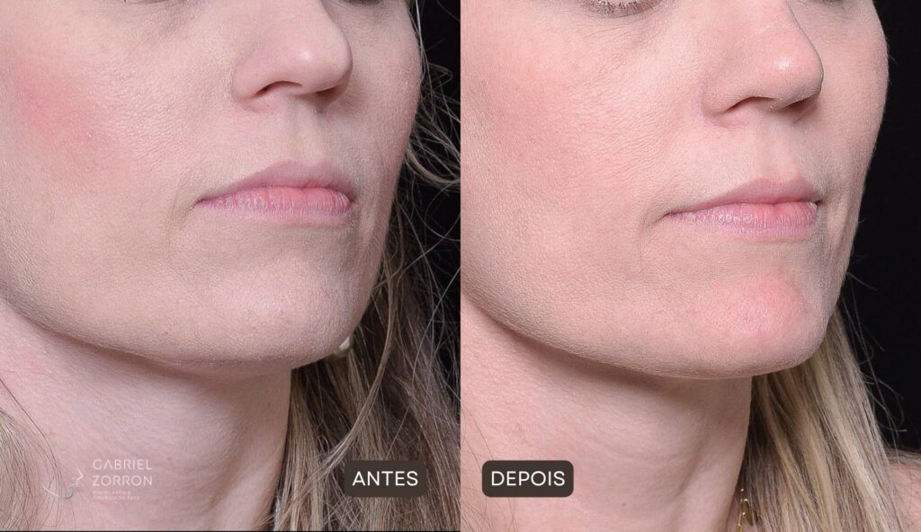 Foto de harmonização facial definitiva, mulher antes da Rinoplastia à esquerda e com Rinoplastia à direita.