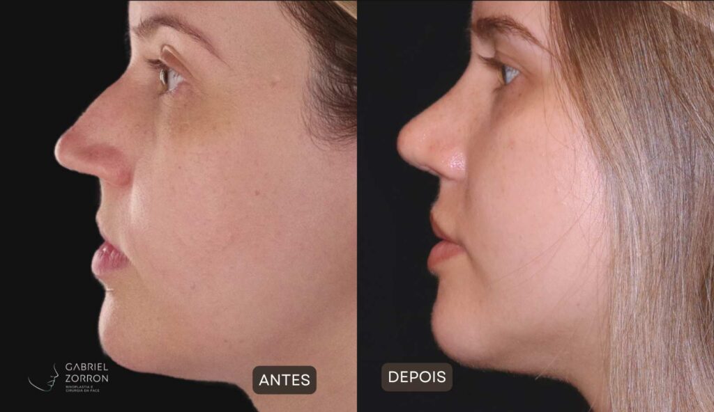 Foto de rinoplastia antes e depois: mulher à esquerda com dorso irregular e à direita com ajustado com naturalidade. 