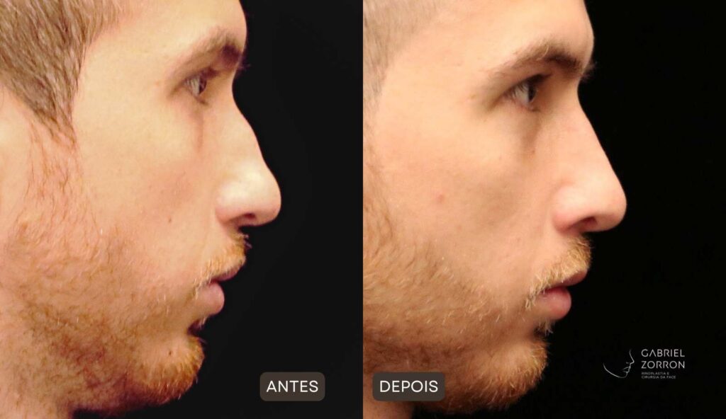 Foto de rinoplastia antes e depois: homem à esquerda com dorso e ponta irregular e à direita com ajustado com naturalidade. 