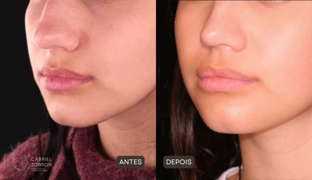 Foto de antes e depois de rinoplastia para "nariz de batata": à esquerda nariz com ponta pouco definida e grande, à direita com ponta afinada e proporcional.