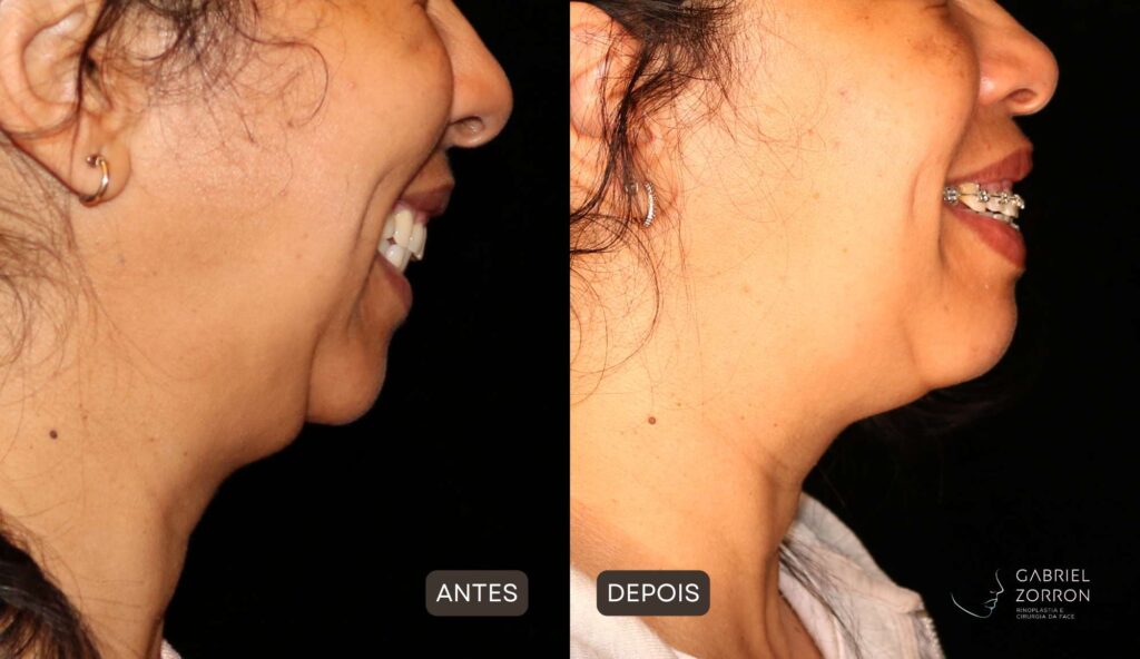 Foto de resultado de cirurgia ortognática em mulher, à esquerda queixo retraído e à direita queixo e sorriso harmonizado.