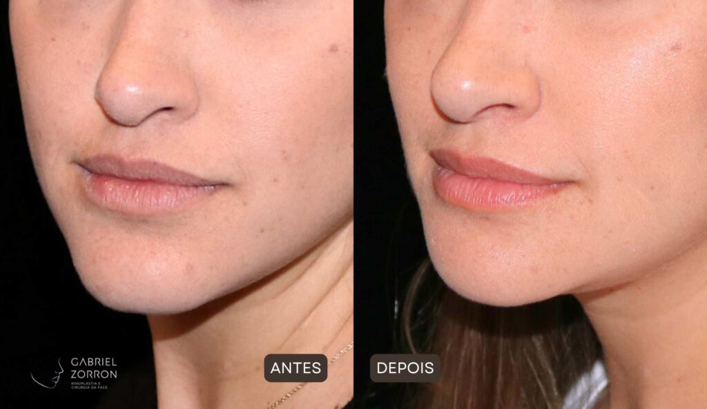 Foto de antes e depois de mentoplastia de redução: à esquerda, rosto feminino com queixo mais projetado. À direita, rosto feminino com queixo mais delicado e contornado.