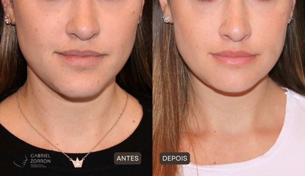 Foto de antes e depois de mentoplastia de redução: à esquerda, rosto feminino com queixo mais projetado. À direita, rosto feminino com queixo mais delicado e contornado.