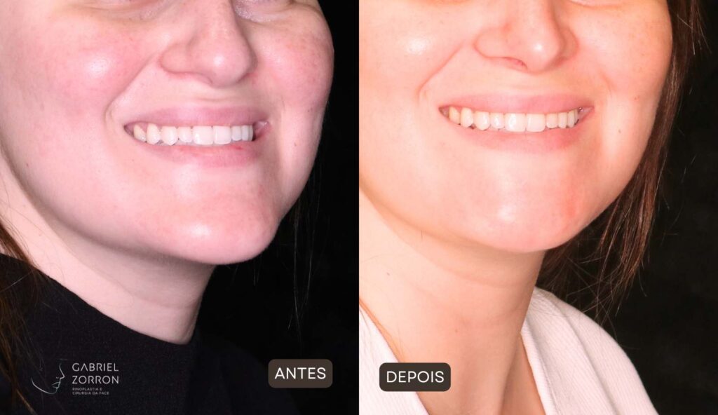 Foto de antes e depois de mentoplastia de redução: à esquerda, rosto feminino com queixo mais projetado. À direita, rosto feminino com queixo mais delicado e contornado.