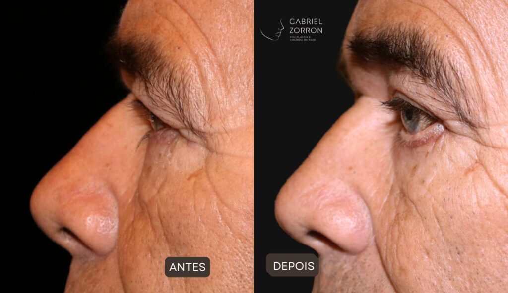 Foto de antes e depois de Blefaroplastia: homem com pálpebras caídas e volumosas à esquerda e com olhar rejuvenescido depois da cirurgia pálpebras à direita.