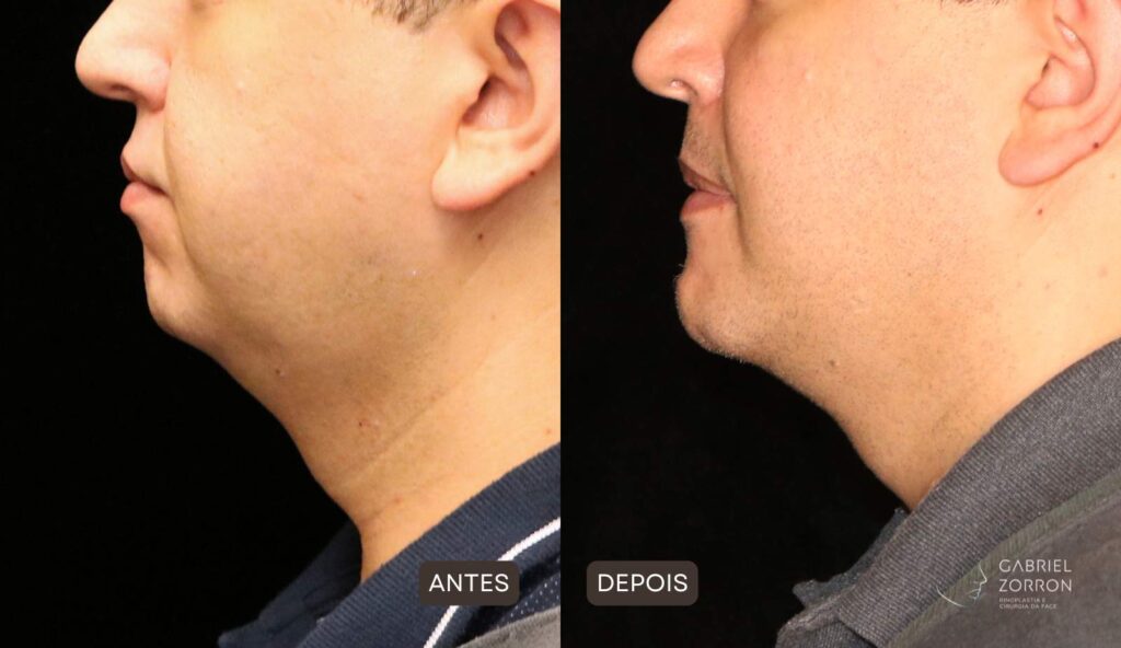 foto de antes e depois de cirurgia ortognática com um dos melhores cirurgiões do brasil - Dr. Gabriel Zorron. À esquerda, homem com queixo pequeno e retraído e a à direita mesmo homem com queixo proporcional e harmônico.