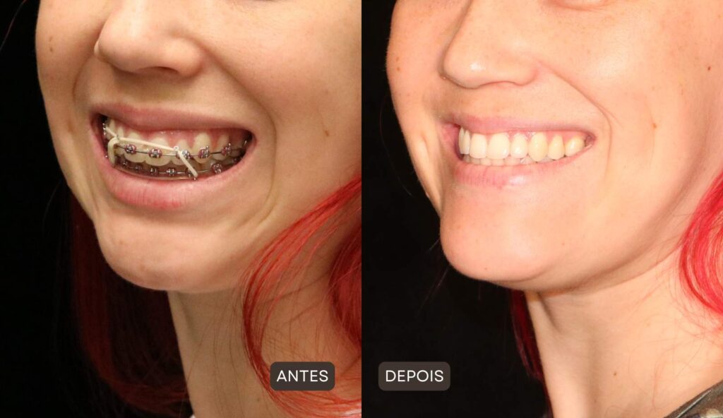 foto de antes e depois de cirurgia ortognática com um dos melhores cirurgiões do brasil - Dr. Gabriel Zorron. À esquerda, mulher com queixo pequeno e retraído e a à direita mesma mulher com queixo proporcional e harmônico, sorriso ajustado na maxila.