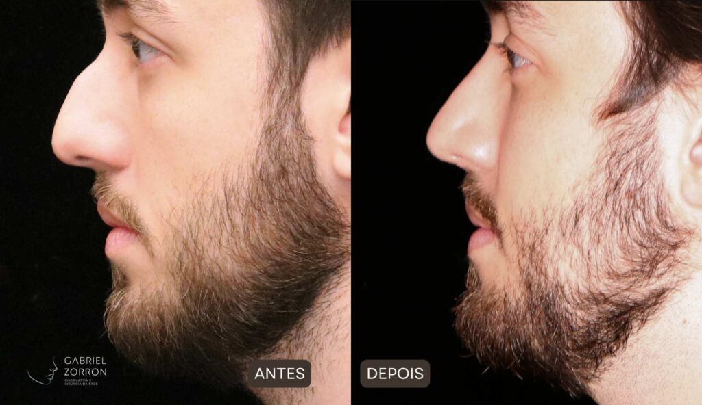 Foto antes e depois de rinoplastia masculina