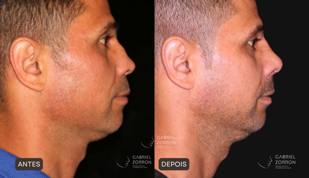 Foto antes e depois de rinoplastia em homem, cirurgia feita por Dr. Gabriel Zorron especialista em rinoplastia e cirurgia da face. À esquerda homem com nariz de dorso elevado e ponta protuberante, à direita dorso reto e ajustado.