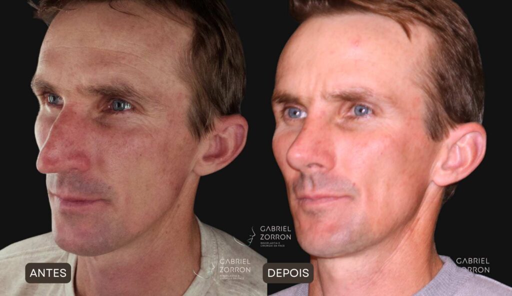 Foto de antes e depois de rinoplastia natural em homem, à esquerda homem com ponta do nariz projetada para frente e dorso irregular e à direita nariz ajustado com ângulo e dorso equilibrados.