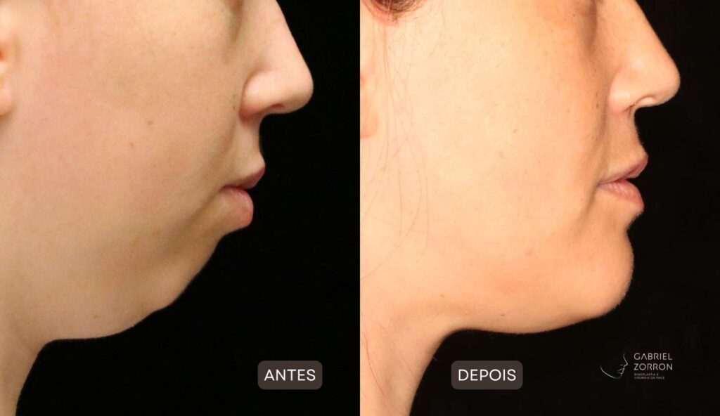 foto de antes e depois de cirurgia ortognatica com um dos melhores cirurgiões do brasil - Dr. Gabriel Zorron. À esquerda, mulher com queixo pequeno e retraído e à direita mulher com queixo proporcional e harmônico.