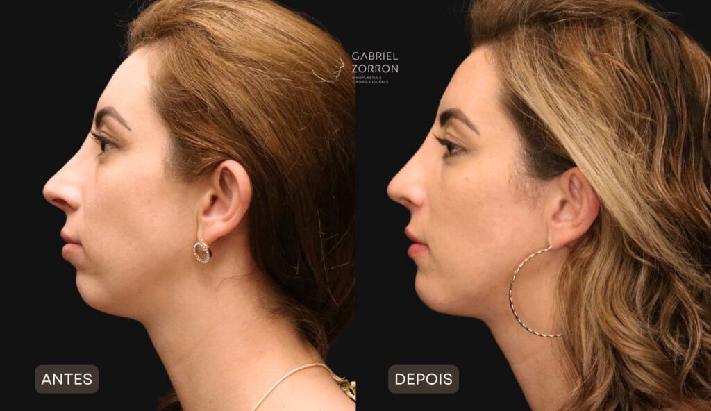 Foto de antes e depois de rinoplastia e mentoplastia, procedimentos feitos em conjunto sendo uma perfiloplastia realizada por Dr Gabriel Zorron especialista.