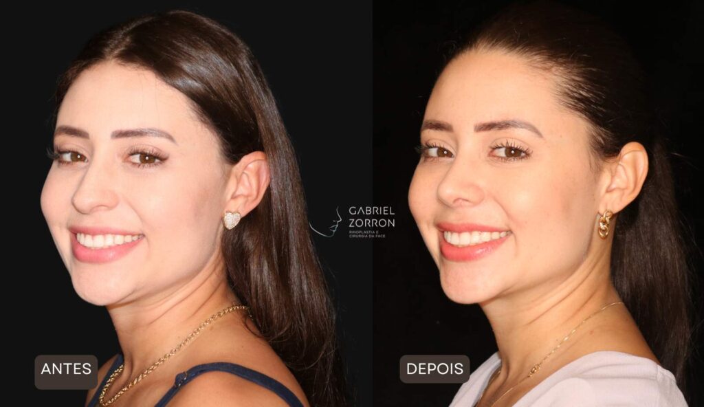 Foto de antes e depois de rinoplastia natural em mulher, à esquerda mulher sorrindo com ponta do nariz levemente projetada para baixo e à direita nariz ajustado com ângulo naturalmente. 