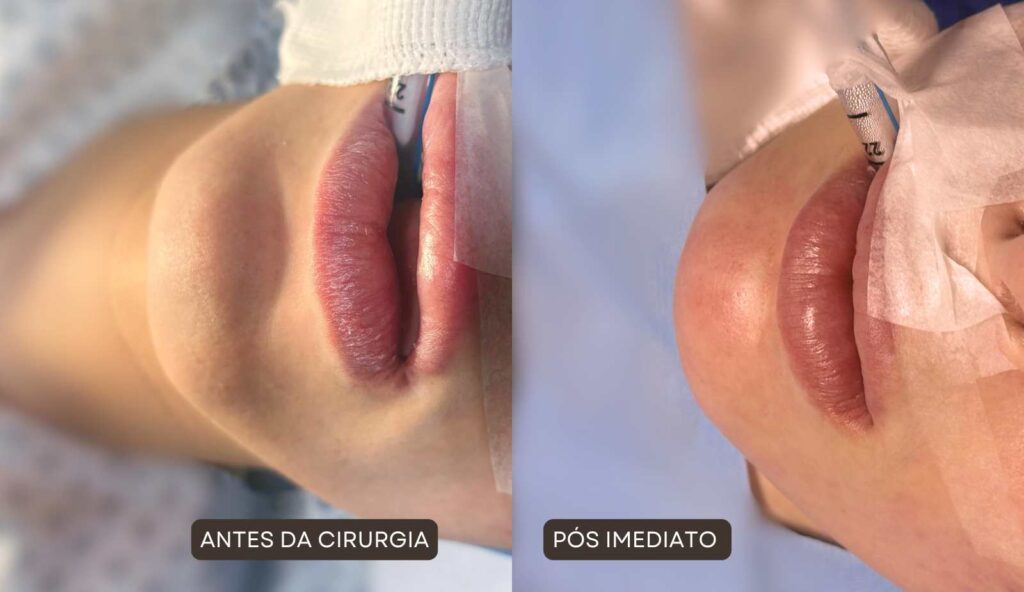 Antes e depois de Feminização Facial com Dr Gabriel Zorron - foco no queixo, tornando-o mais delicado, definido e feminino.