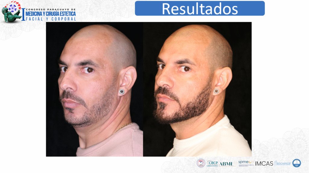 Imagem de antes e depois paciente do Dr Gabriel Zorron, cirurgião plástico da face, apresentada no congresso paraguaio de cirurgia estética. Cirurgia feita foi ortognática com implante facial.