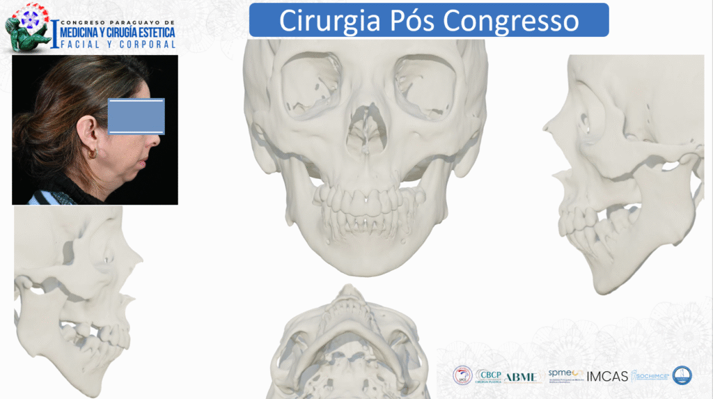 Imagem paciente do Dr Gabriel Zorron, cirurgião plástico da face, apresentada no congresso paraguaio de cirurgia estética. Cirurgia ao vivo para outros médicos.