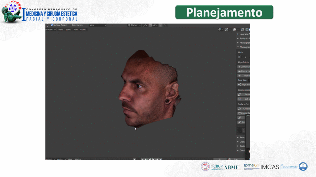 Imagem da simulação 3D de paciente do Dr Gabriel Zorron, cirurgião plástico da face, apresentada no congresso paraguaio de cirurgia estética.