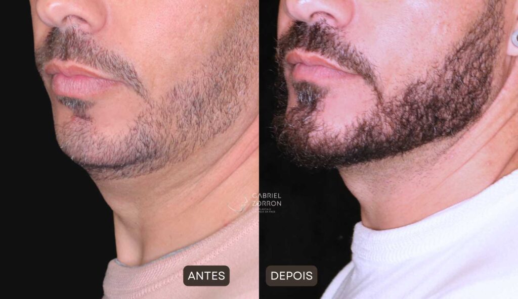 foto de antes e depois de cirurgia para aumentar o queixo e a mandíbula, na esquerda homem com queixo pequeno e retraído, na direita homem com o queixo equilibrado por meio de cirurgia ortognática e implante facial realizada pelo cirurgião especialista em face Gabriel Zorron.