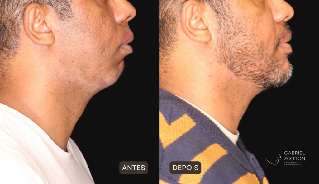foto de antes e depois de cirurgia para aumentar o queixo e a mandíbula, na esquerda homem com queixo pequeno e retraído, na direita homem com o queixo equilibrado por meio de cirurgia ortognática e implante facial realizada pelo cirurgião especialista em face Gabriel Zorron.