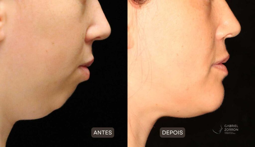 foto de antes e depois de cirurgia para aumentar o queixo e a mandíbula, na esquerda mulher com queixo pequeno e retraído, na direita mulher com o queixo equilibrado por meio de cirurgia realizada pelo cirurgião especialista em face Gabriel Zorron.