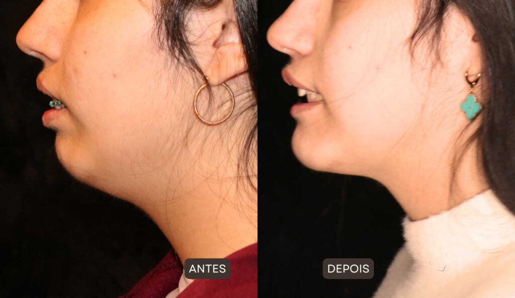 foto de antes e depois de cirurgia para aumentar o queixo e a mandíbula, na esquerda mulher com queixo pequeno e retraído, na direita mulher com o queixo equilibrado por meio de cirurgia realizada pelo cirurgião especialista em face Gabriel Zorron.