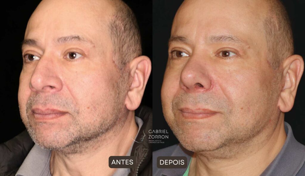 foto antes e depois rinoplastia secundária com dr gabriel zorron