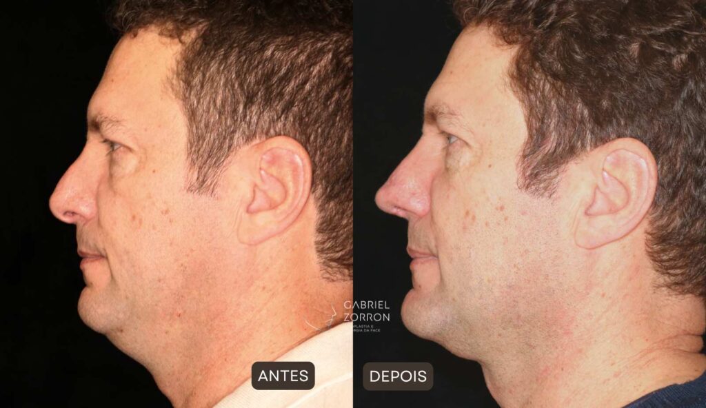 foto antes e depois rinoplastia secundária com dr gabriel zorron