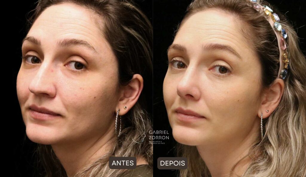 foto antes e depois rinoplastia secundária com dr gabriel zorron