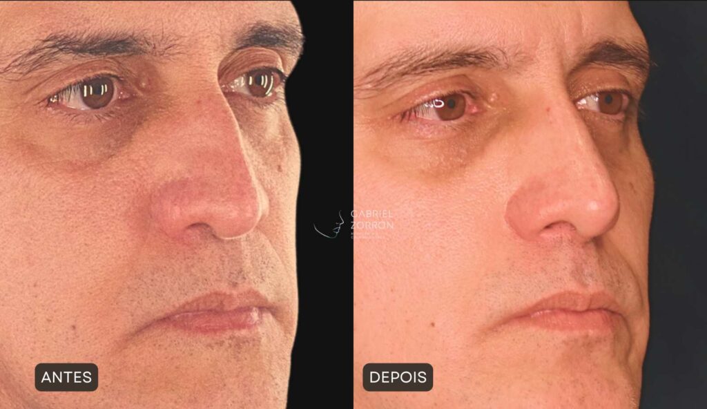 Rinoplastia em Curitiba: foto de antes e depois de cirurgia plástica no nariz em homem, rinoplastia masculina por Dr Gabriel Zorron, especialista em Rinoplastia e cirurgia da face.