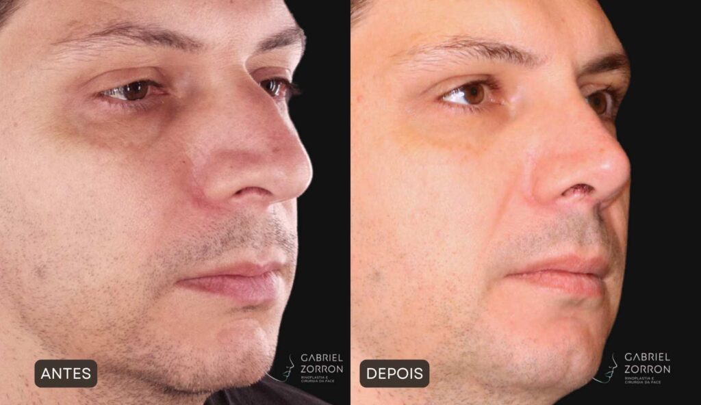 Rinoplastia em Curitiba: foto de antes e depois de cirurgia plástica no nariz em homem, rinoplastia masculina por Dr Gabriel Zorron, especialista em Rinoplastia e cirurgia da face.