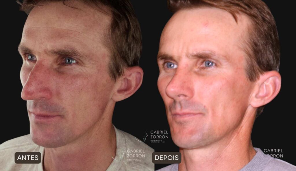 Rinoplastia em Curitiba: foto de antes e depois de cirurgia plástica no nariz em homem, rinoplastia masculina por Dr Gabriel Zorron, especialista em Rinoplastia e cirurgia da face.