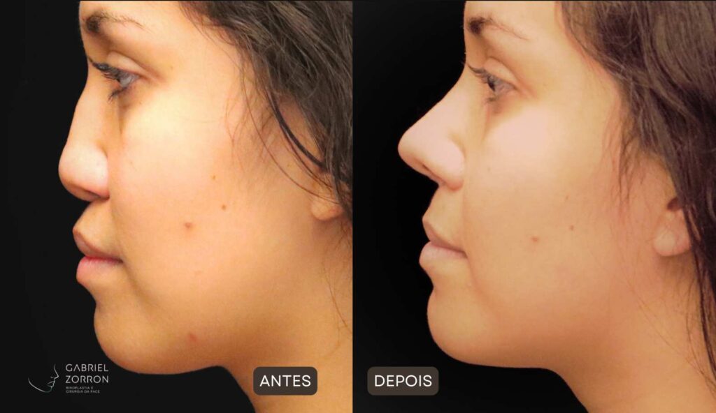 Rinoplastia em Curitiba: foto de antes e depois de cirurgia plástica no nariz em mulher, rinoplastia feminina por Dr Gabriel Zorron, especialista em Rinoplastia e cirurgia da face.