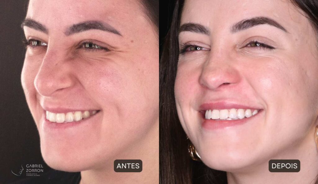 Rinoplastia em Curitiba: foto de antes e depois de cirurgia plástica no nariz em mulher, rinoplastia feminina por Dr Gabriel Zorron, especialista em Rinoplastia e cirurgia da face.