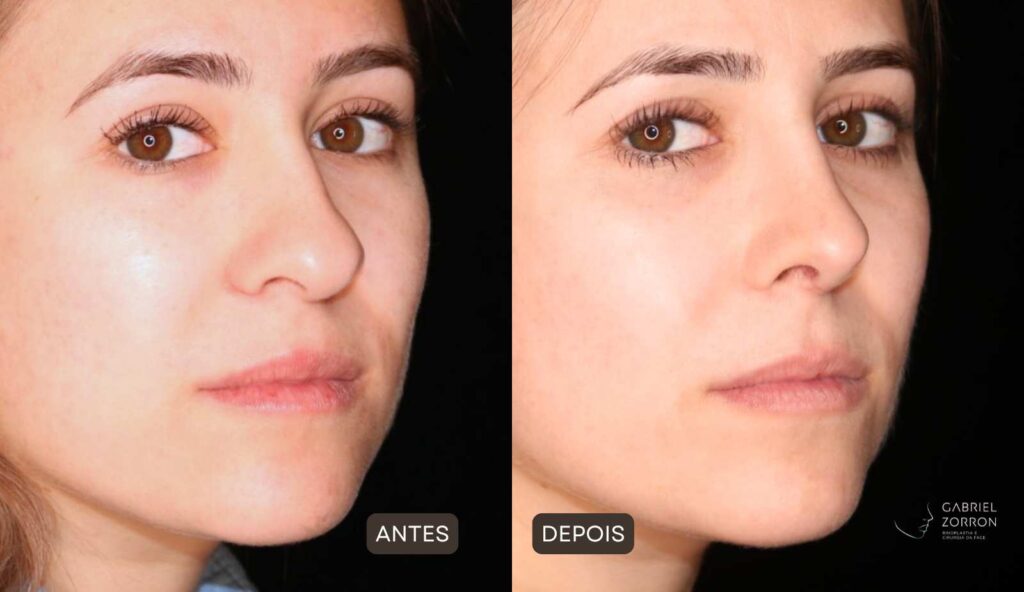 Rinoplastia em Curitiba: foto de antes e depois de cirurgia plástica no nariz em mulher, rinoplastia feminina por Dr Gabriel Zorron, especialista em Rinoplastia e cirurgia da face.