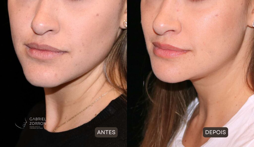 foto antes e depois cirurgia para diminuir o queixo com Dr Gabriel Zorron, cirurgião crânio-maxilo-facial