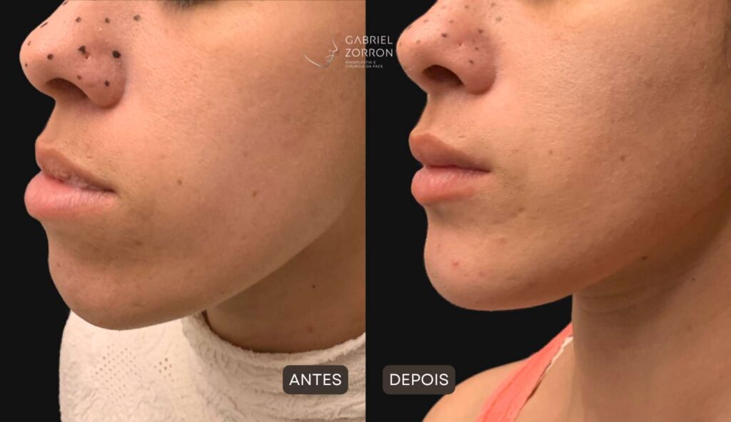 foto antes e depois cirurgia para diminuir o queixo com Dr Gabriel Zorron, cirurgião crânio-maxilo-facial