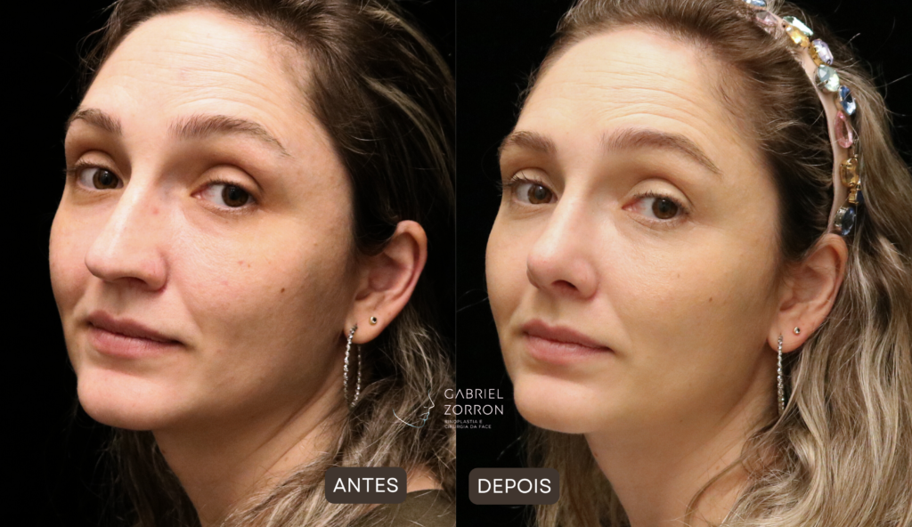 foto de antes e depois de rinoplastia com dr gabriel zorron especialista