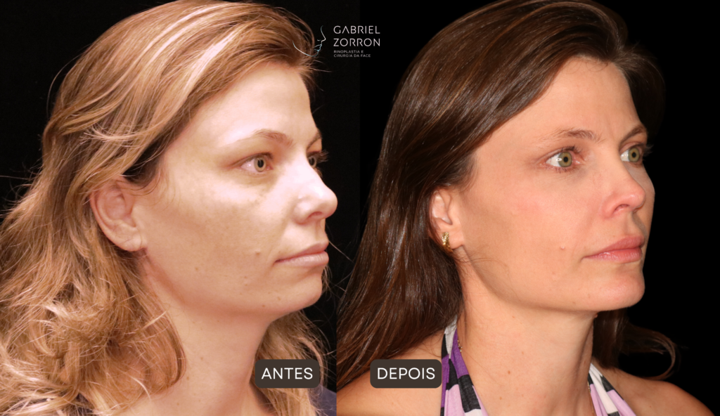foto de antes e depois de rinoplastia com mentoplastia com dr gabriel zorron especialista