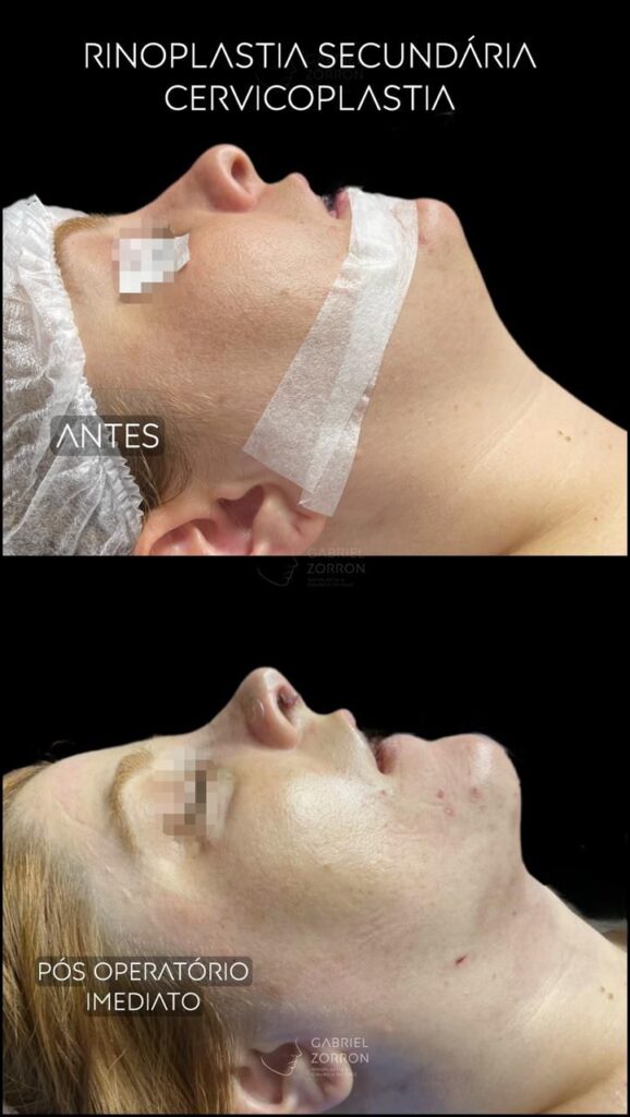 foto antes e depois de cervicoplastia