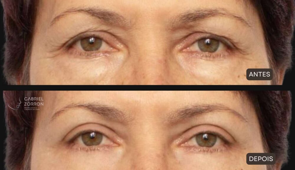 Antes e depois de blefaroplastia em mulher.
