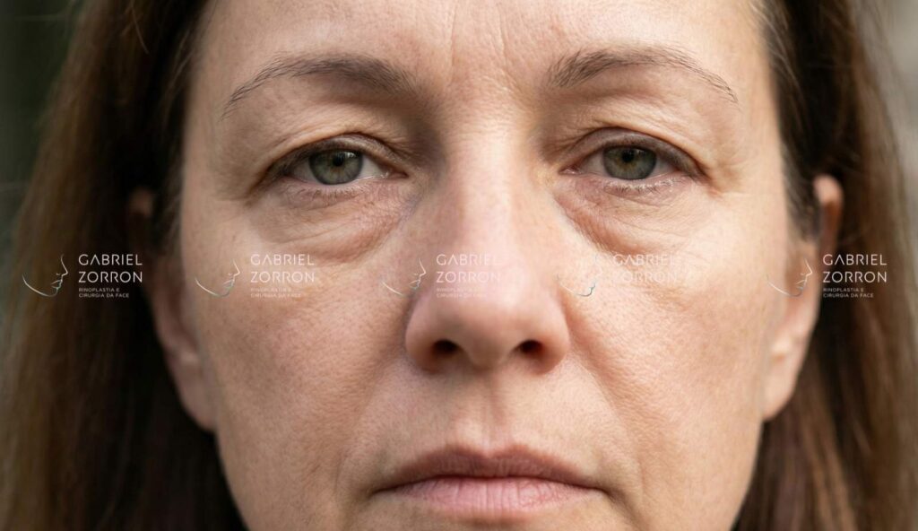 Exemplo de olhar cansado para fazer a Blefaroplastia.